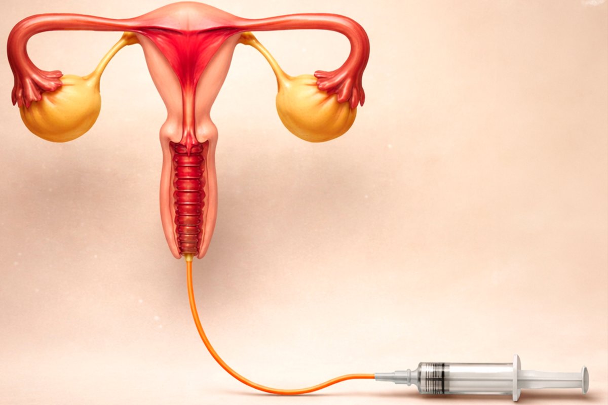 Inseminação Intrauterina (IIU) em São Paulo: Preço e Sucesso