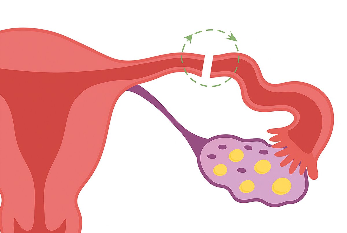 Reversão de Laqueadura: Quando Tentar?
