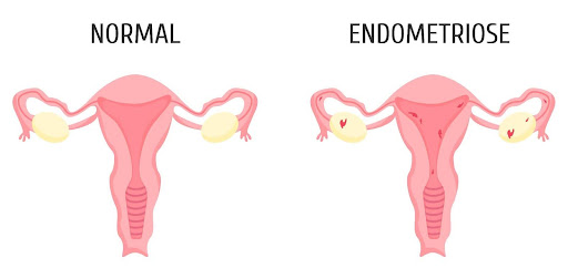 O que é e quais são os tipos de endometriose